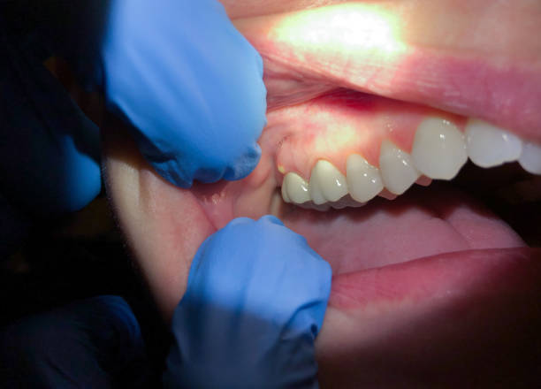 Best Emergency Root Canal Treatment in Madison Center, CT